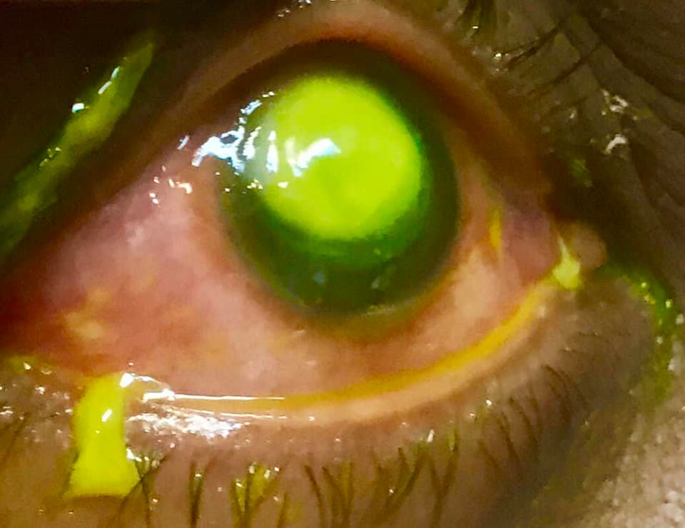 Κοιμάστε με τους φακούς επαφής; Δείτε τις φωτογραφίες που δημοσίευσε ένας οφθαλμίατρος και δεν θα το ξανακάνετε!