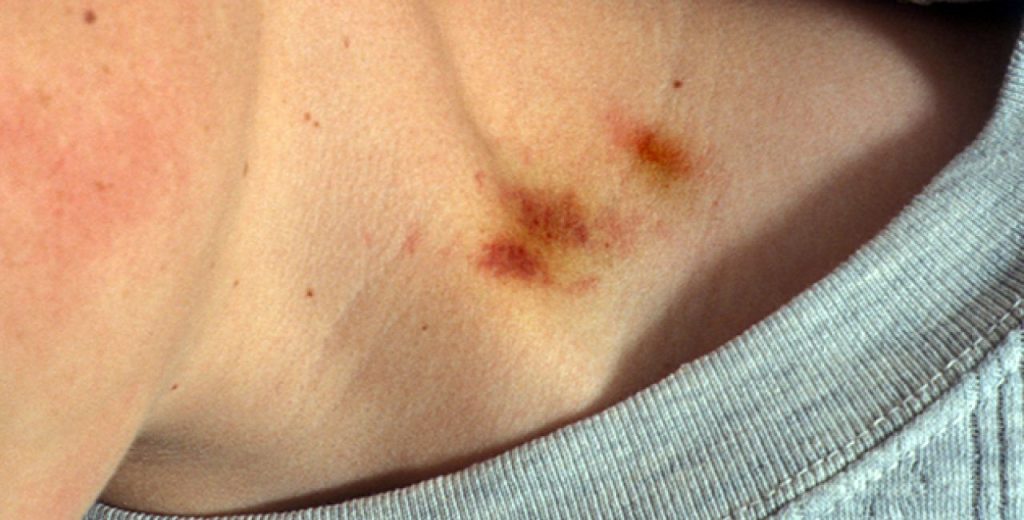 Κι όμως λειτουργεί: Αυτό είναι το κόλπο για να φύγει εύκολα και γρήγορα… η πιπιλιά από τον λαιμό