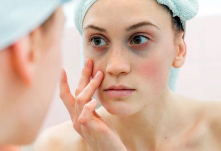 Με αυτές τις τροφές ξεχνάς τους μαύρους κύκλους!