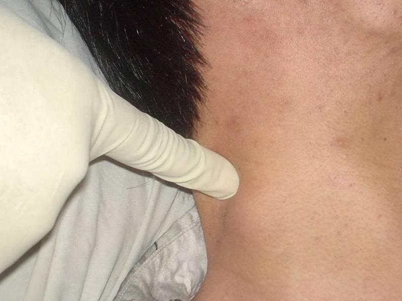 Πώς γίνεται η αποτοξίνωση στους λεμφαδένες; – Λέμφωμα και πρόληψη