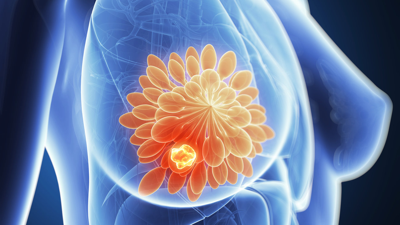 Επιστήμονες μετατρέπουν επιτυχώς τα κύτταρα του καρκίνου του μαστού σε λίπος για να τα σταματήσουν τη διάδοση