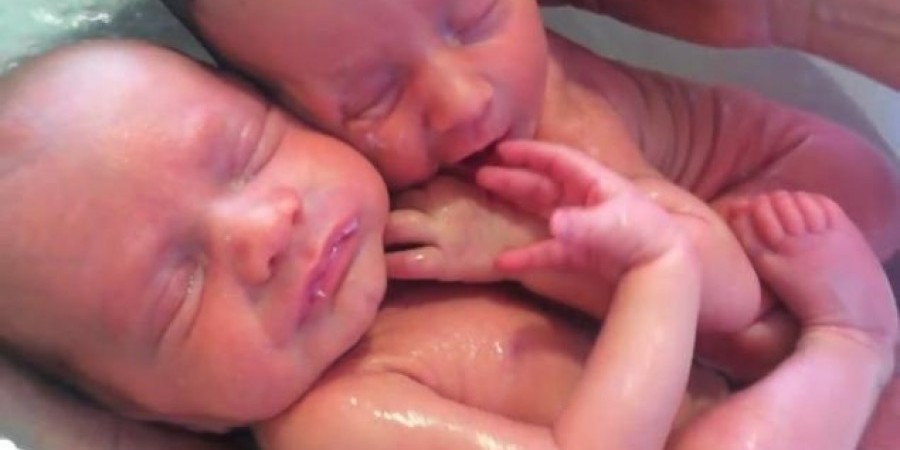 Τα δίδυμα που κινδύνεψαν στη γέννα και γεννήθηκαν αγκαλιασμένα