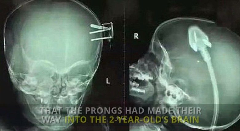 Ακτινογραφία μικρού παιδιού ανατριχιάζει με τα ευρήματά της (βίντεο)