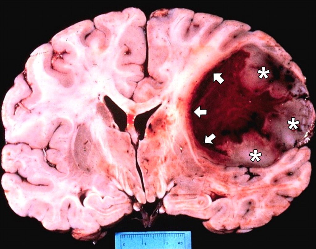 Ο καρκίνος ξεκινά από το μυαλό – Τα σημεία του σώματος που προσβάλλονται ανάλογα με τη διάθεση μας (βίντεο)