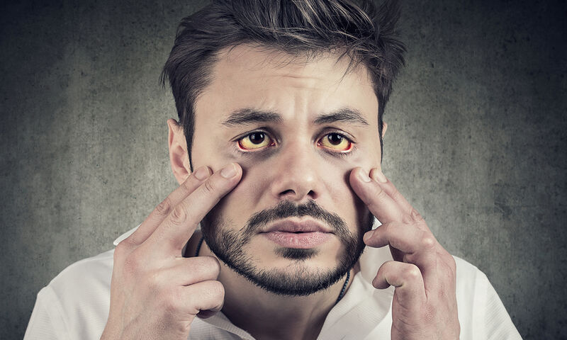 10 πιθανές αιτίες που κάνουν τα μάτια μας κίτρινα
