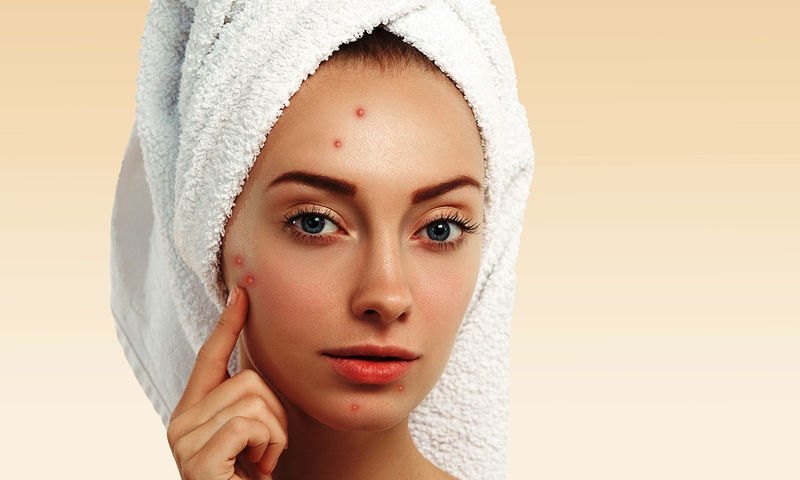 Είναι φυσιολογική η εφηβική ακμή; – Τι δείχνουν οι έρευνες