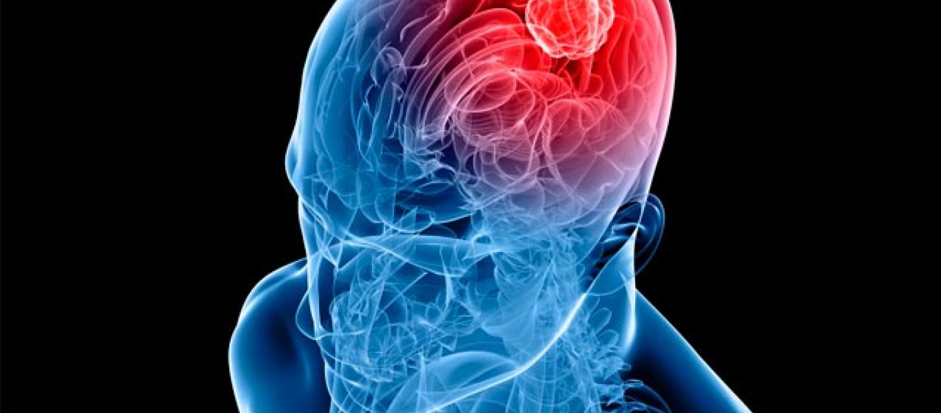 Όγκος στον εγκέφαλο: Τα 8 συμπτώματα που δείχνουν ότι κάτι «τρέχει»