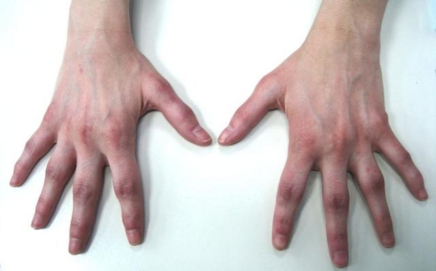 Αρθρίτιδα: Μπορεί να βοηθήσει η σύγχρονη χειρουργική;