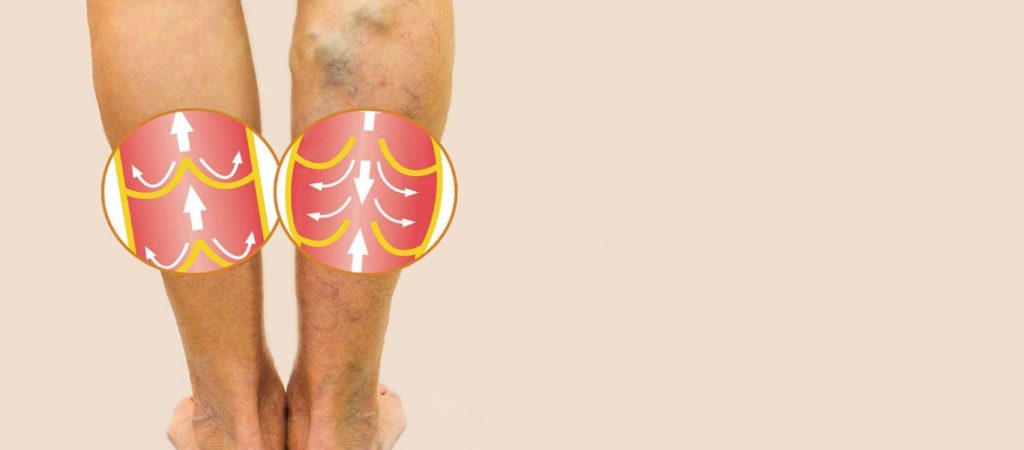 Οι τροφές και τα μπαχαρικά που προλαμβάνουν τη θρόμβωση