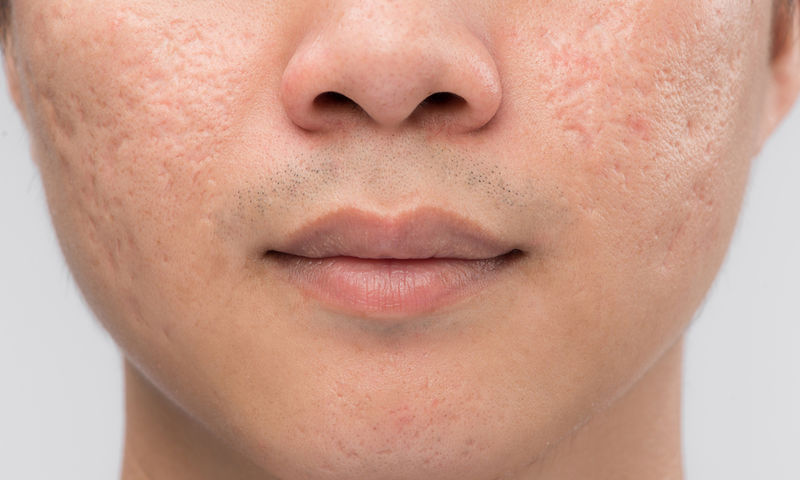 Γιατί αυτοί οι παράγοντες προκαλούν ακμή;