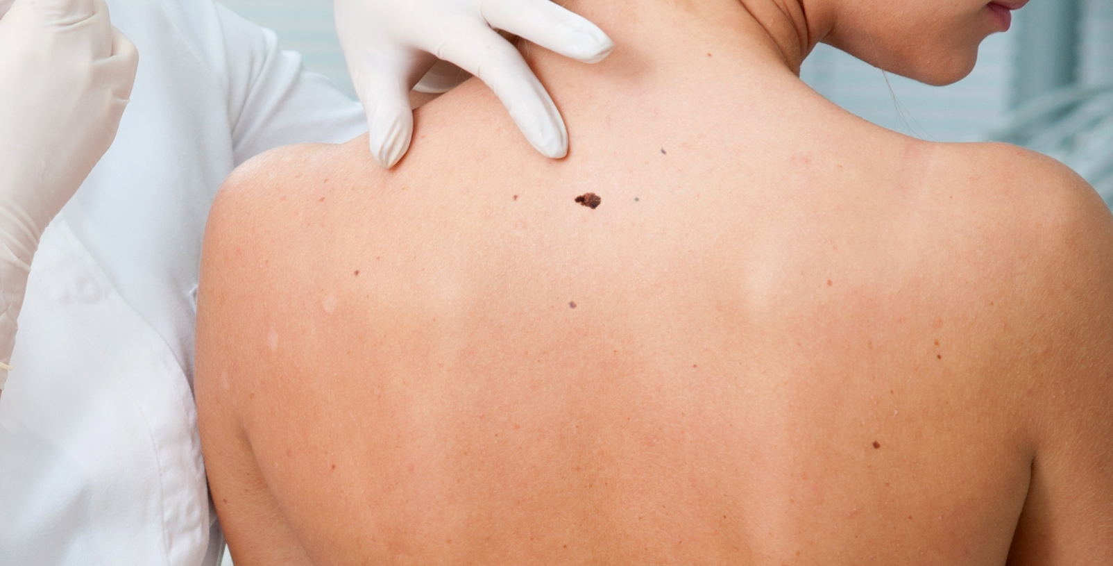 Καρκίνος του δέρματος: Πότε η φαγούρα σε μια ελιά πρέπει να σας ανησυχήσει
