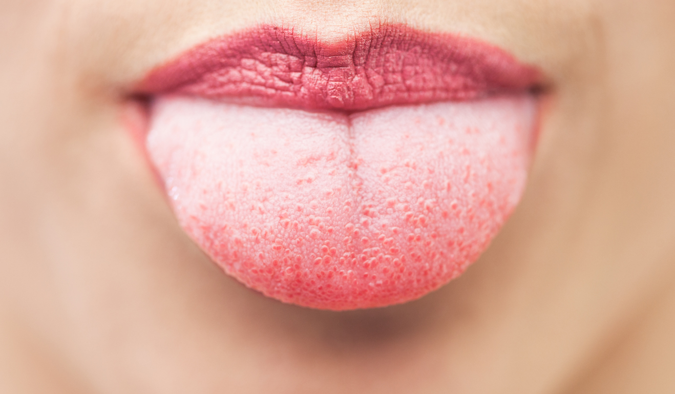 Άσπρη γλώσσα: Για ποιον λόγο συμβαίνει και τι πρέπει να κάνετε στο σπίτι