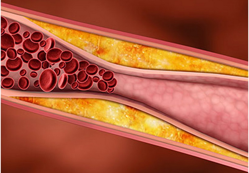 Αυτοί είναι οι τρόποι για να μειώσετε την χοληστερίνη