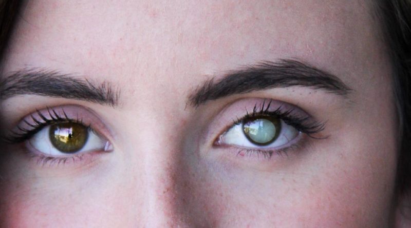 Ποια τα οφέλη της επέμβασης καταρράκτη στην οδήγηση;