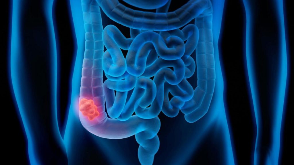 Η αντιφλεγμονώδης διατροφή που μειώνει τον κίνδυνο εμφάνισης καρκίνου παχέος εντέρου