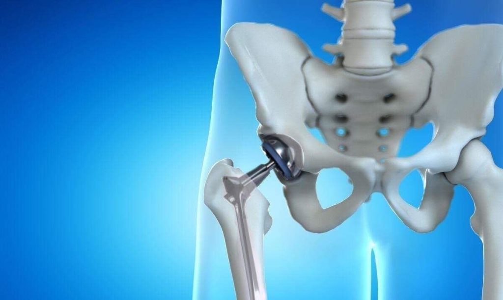 Oι βιταμίνες που αυξάνουν τον κίνδυνο κατάγματος του ισχίου