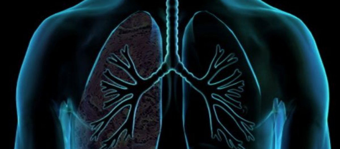 Αν έχετε αυτά τα συμπτώματα έχετε συσσώρευση υγρού στον πνεύμονα