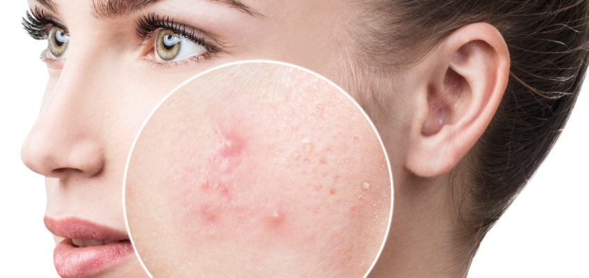 Πώς προστατεύω ένα πρόσωπο με ακμή; – Μυστικά για να πάψετε να έχετε σπυράκια