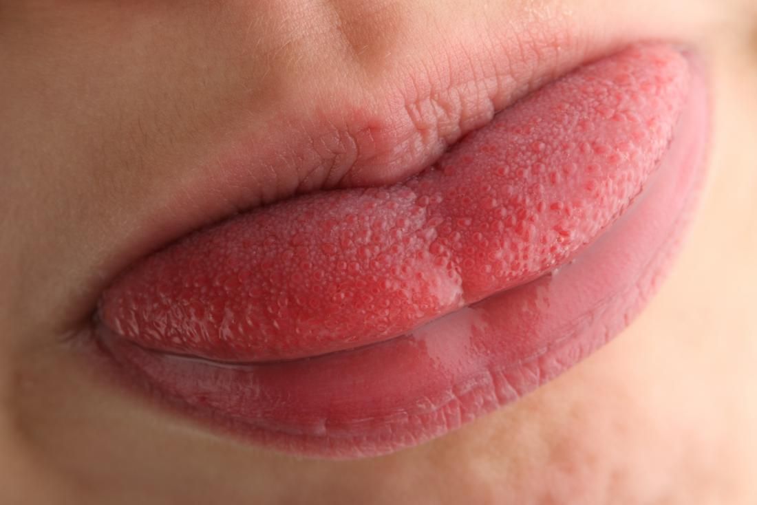 Δάγκωμα της γλώσσας: Γρήγορη αντιμετώπιση για το τραύμα