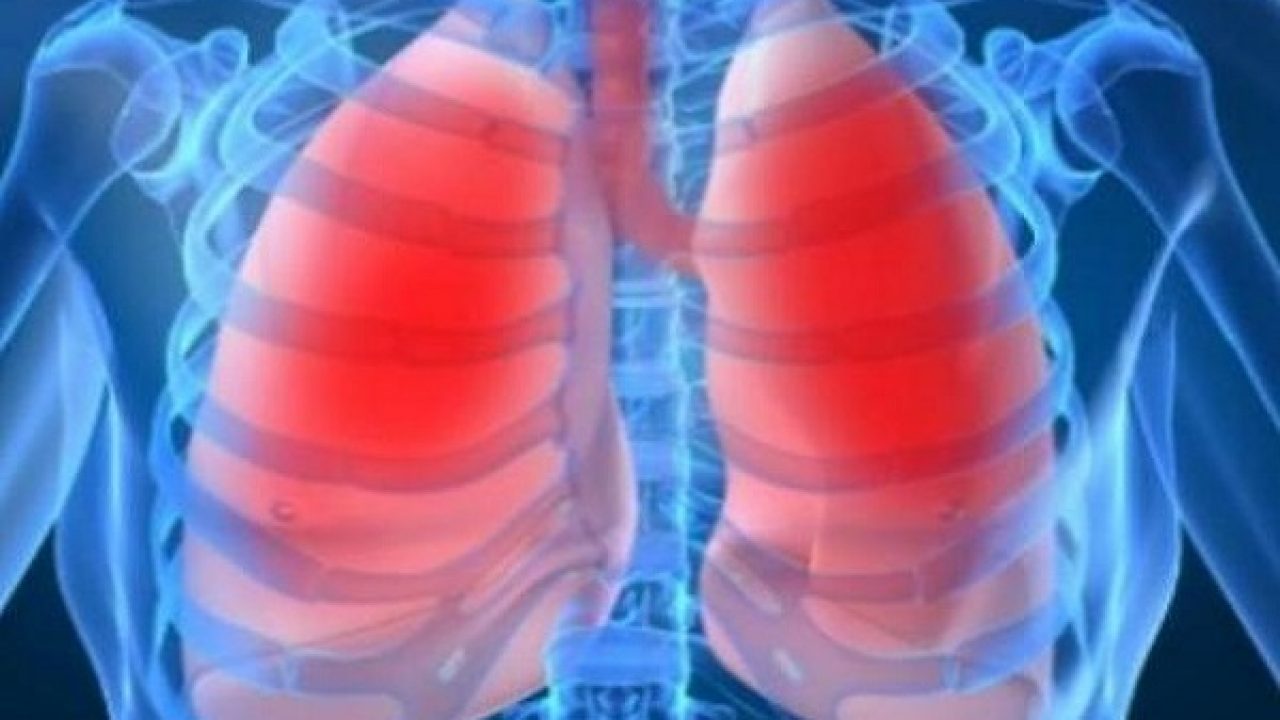 Πνευμονία: Ποιοι κινδυνεύουν και ποιες είναι οι σοβαρές επιπλοκές