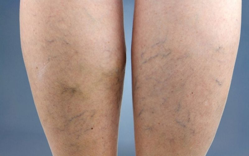 Ποιες είναι οι κατηγορίες και ποια τα συμπτώματα της φλεβίτιδας;