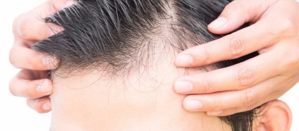 Υπάρχουν δραστικές λύσεις κατά της φαλάκρας;