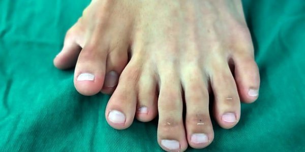 Κινέζος γεννήθηκε με 9 δάχτυλα στο πόδι – Πραγματοποίησε την εγχείρηση που του άλλαξε τη ζωή (φώτο)