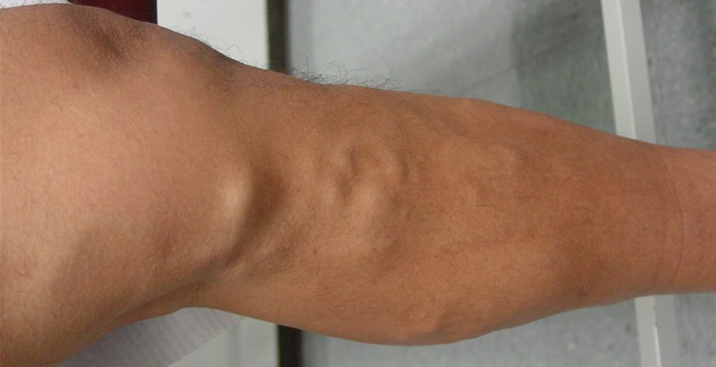 Κιρσοί: Αυτές είναι οι σοβαρές ασθένειες που μπορεί να κρύβουν