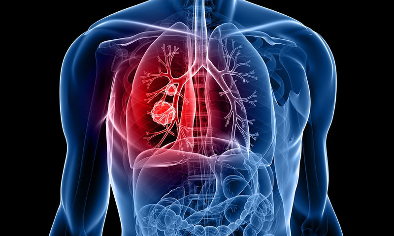 Πόσο συχνός είναι ο καρκίνος του πνεύμονα; – Συχνότερος σε άνδρες ή γυναίκες;
