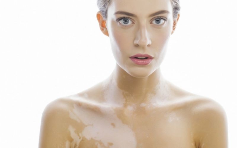 Το φως στο επίκεντρο της θεραπείας κατά της λεύκης