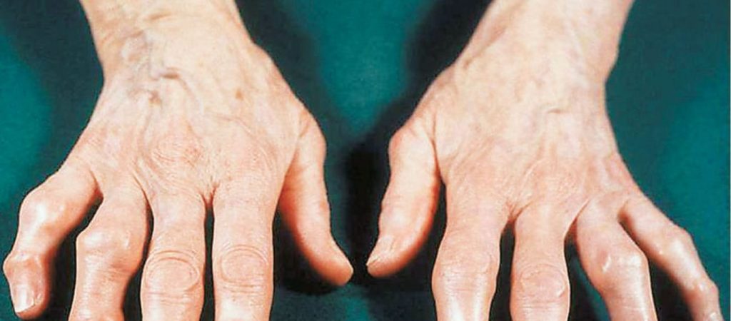 Ρευματοειδής αρθρίτιδα: Αυτές είναι οι 33 τροφές που μειώνουν τον πόνο