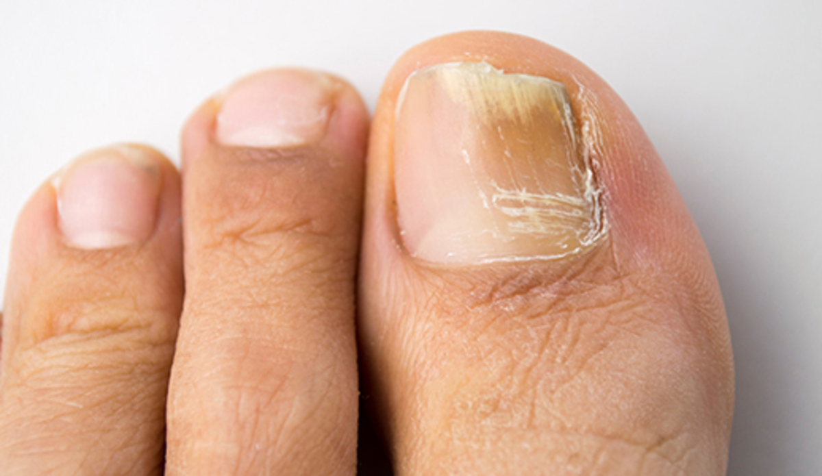 Μύκητες στα νύχια χεριών και ποδιών: Οκτώ κανόνες πρόληψης