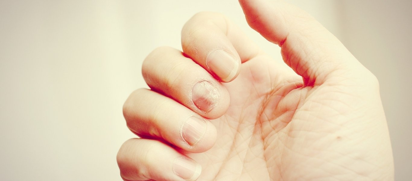 Νύχια που κιτρινίζουν: Δείτε τις 3+1 πιθανές αιτίες
