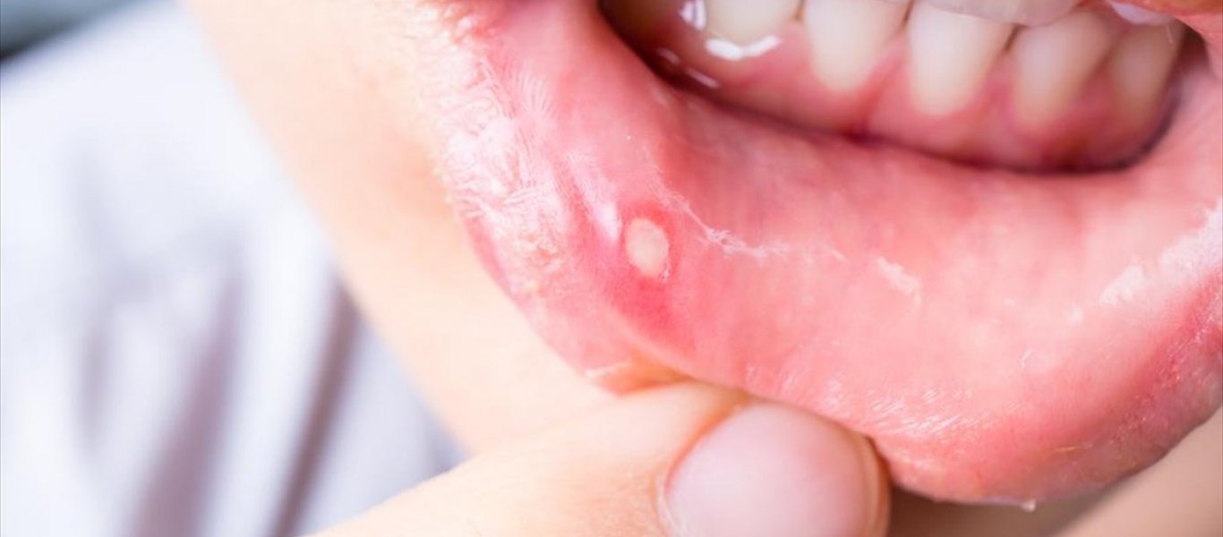 Όλα όσα πρέπει να γνωρίζετε για τις άφτρες στο στόμα: Αίτια – Συμπτώματα και αντιμετώπιση