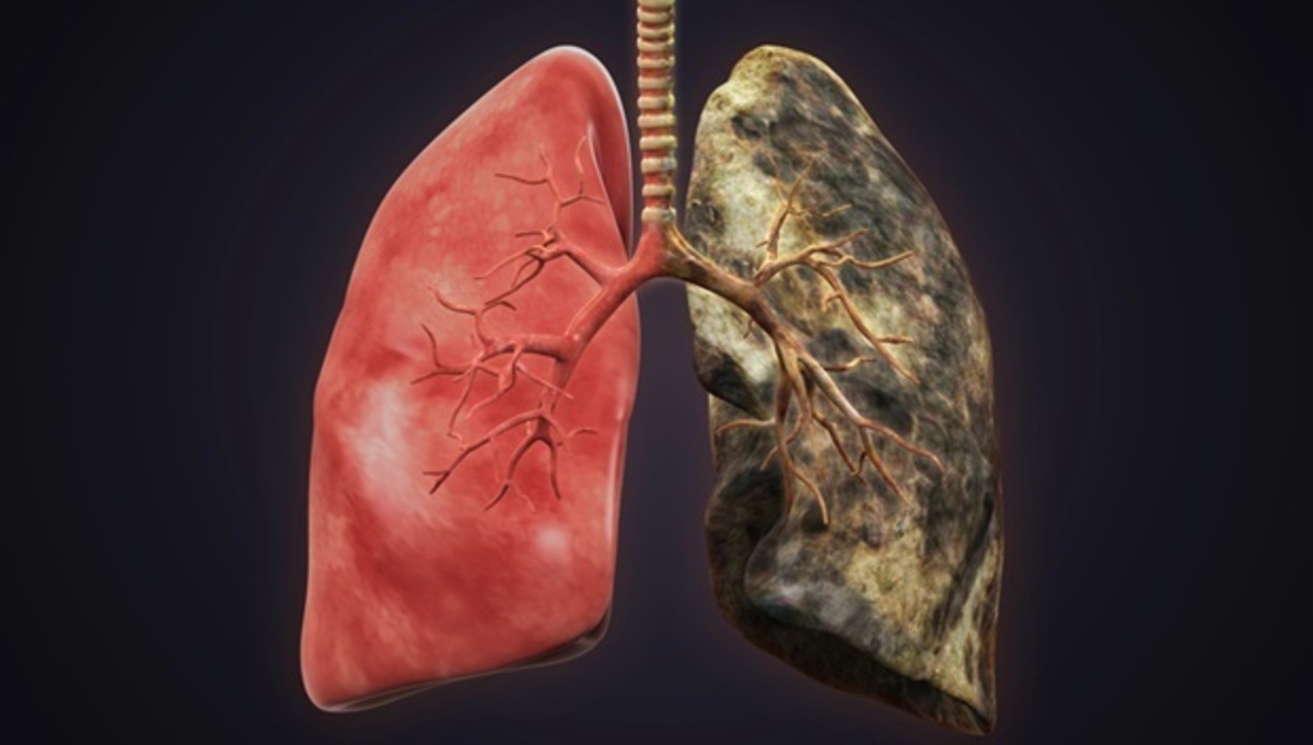 Δείτε πως είναι οι πνεύμονες ενός χρόνιου καπνιστή (βίντεο)
