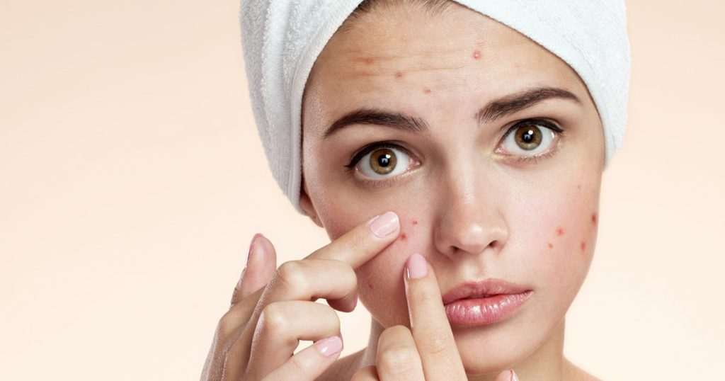 Οι τροφές που προκαλούν έξαρση στην ακμή