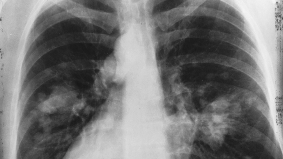 Η πρώτη αιτία θνησιμότητας στην Ελλάδα – Πώς θα μειωθούν οι θάνατοι από αυτήν;