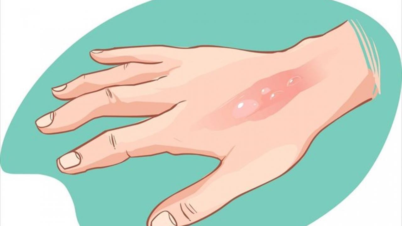 Όλα όσα πρέπει να γνωρίζετε για τα εγκαύματα: Πως αντιμετωπίζουμε το θερμικό – το χημικό και αυτό στην κουζίνα (βίντεο)