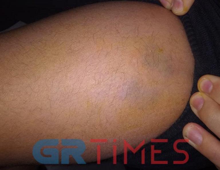 Θεσσαλονίκη: Αδέσποτα σκυλιά δάγκωσαν μαθητές