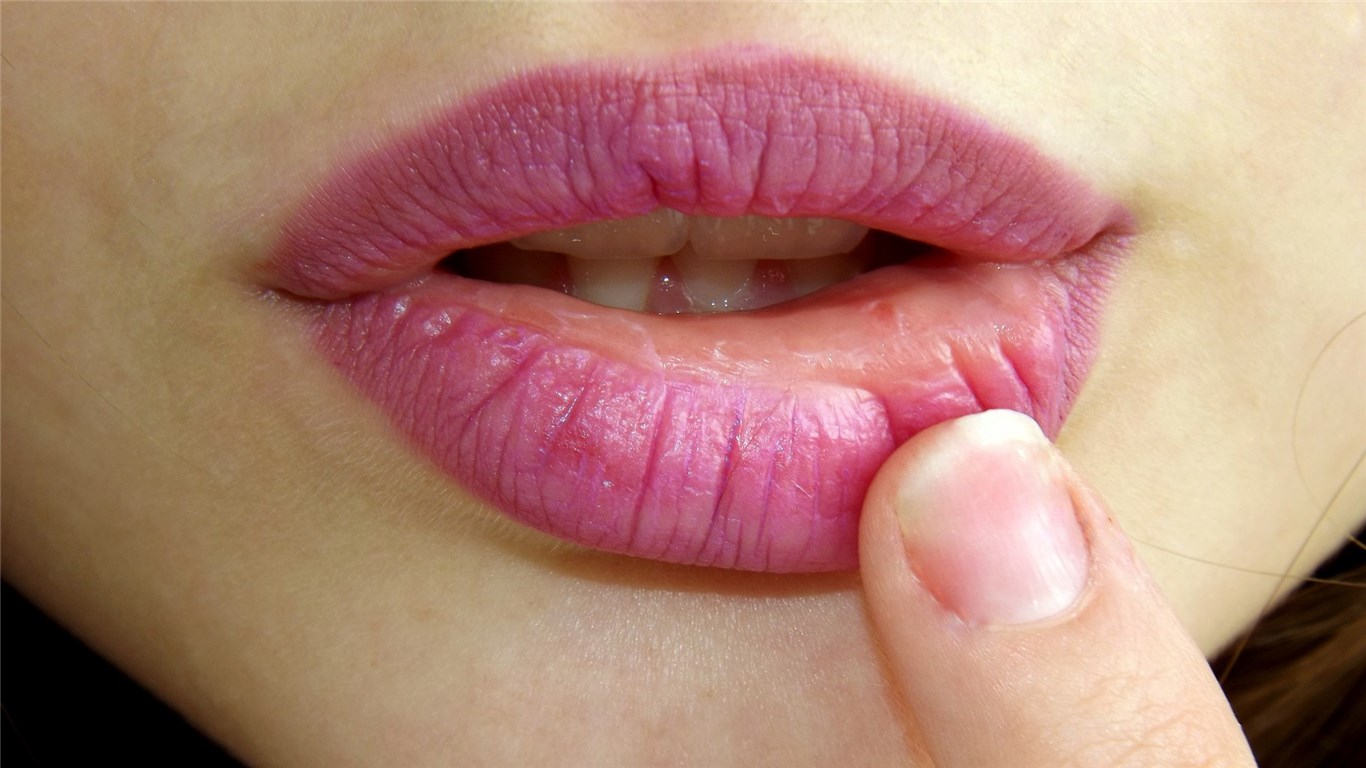 Σκασμένα χείλη: Εννιά συμβουλές για να τα αντιμετωπίσετε