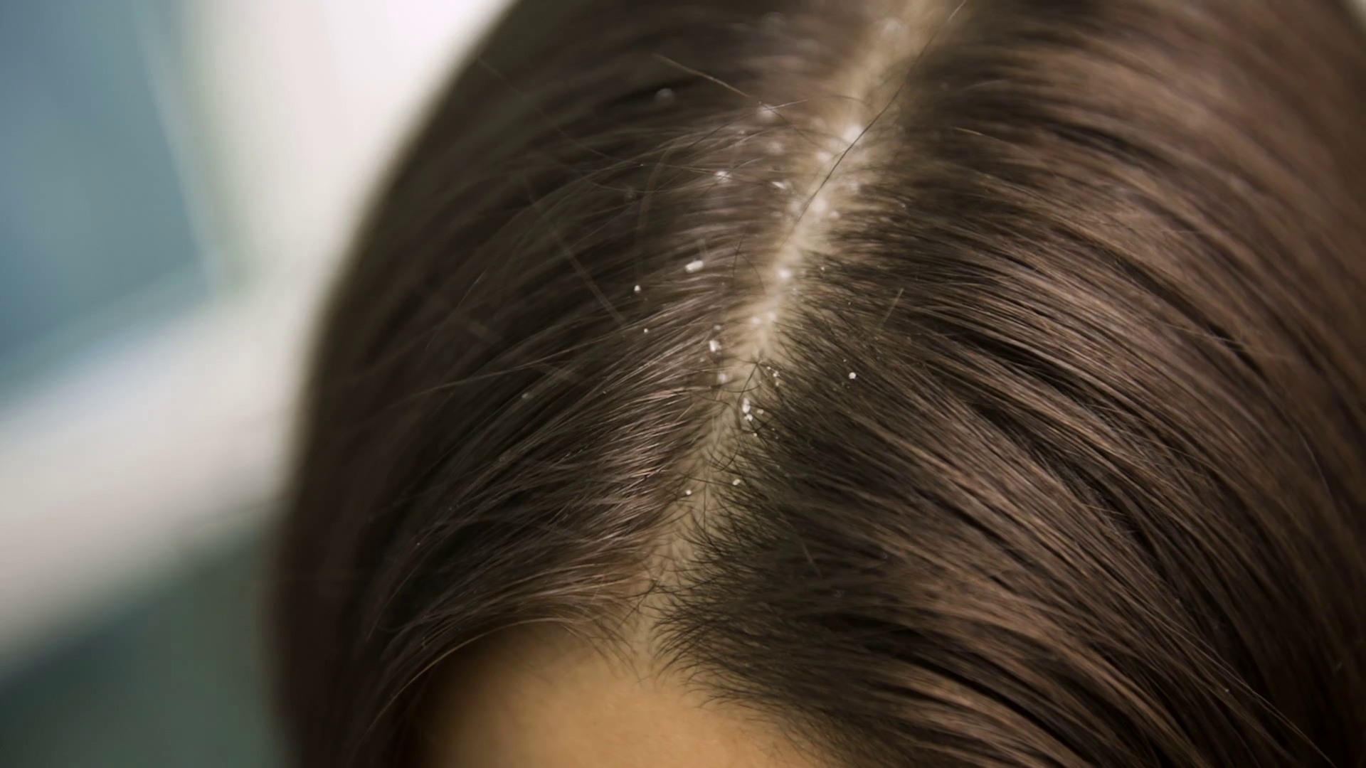 Άσπρες νιφάδες στα μαλλιά: Πότε είναι πιτυρίδα και πότε ξηροδερμία; – Ιδού η απάντηση