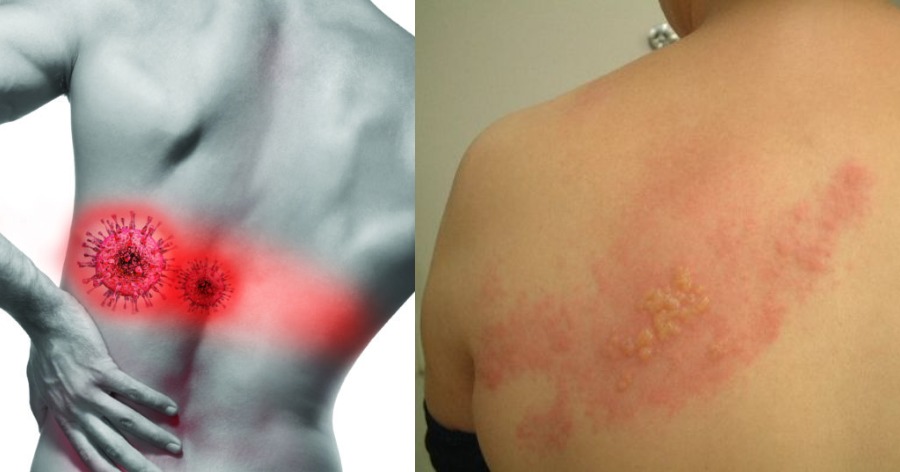 Έρπης ζωστήρας: Ποια τα συμπτώματα της νόσου; – Πώς την αντιμετωπίζετε;