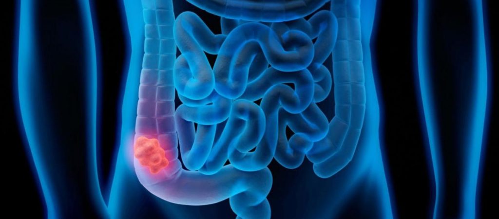 Συχνή κατανάλωση αυτού του τροφίμου μειώνει τον κίνδυνο εμφάνισης καρκίνου του παχέος εντέρου