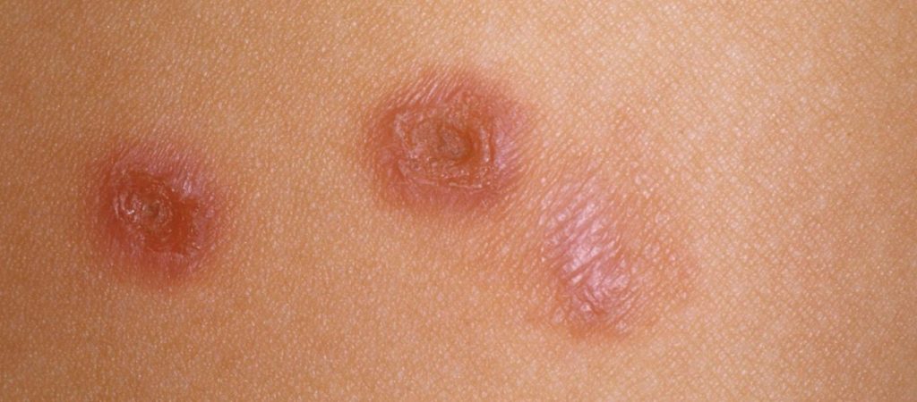 Σταφυλόκοκκος: Πώς θα καταλάβεις τα συμπτώματα;