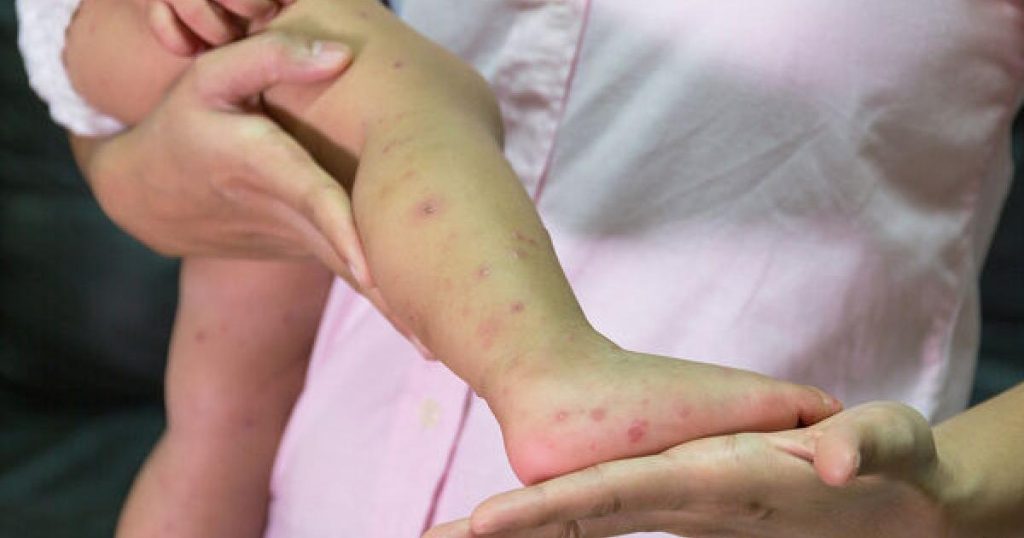 Tι είναι ο ιός κοξάκι και τι πρέπει να γνωρίζετε για την πρόληψή του;