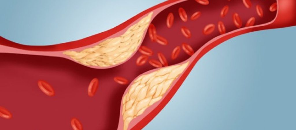 Με αυτόν τον τρόπο θα… «καθαρίσετε» τις αρτηρίες σας