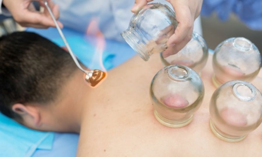 Τι ισχύει με τις βεντούζες με ποτήρια; – Πόσο βοηθούσαν τελικά την υγεία μας;