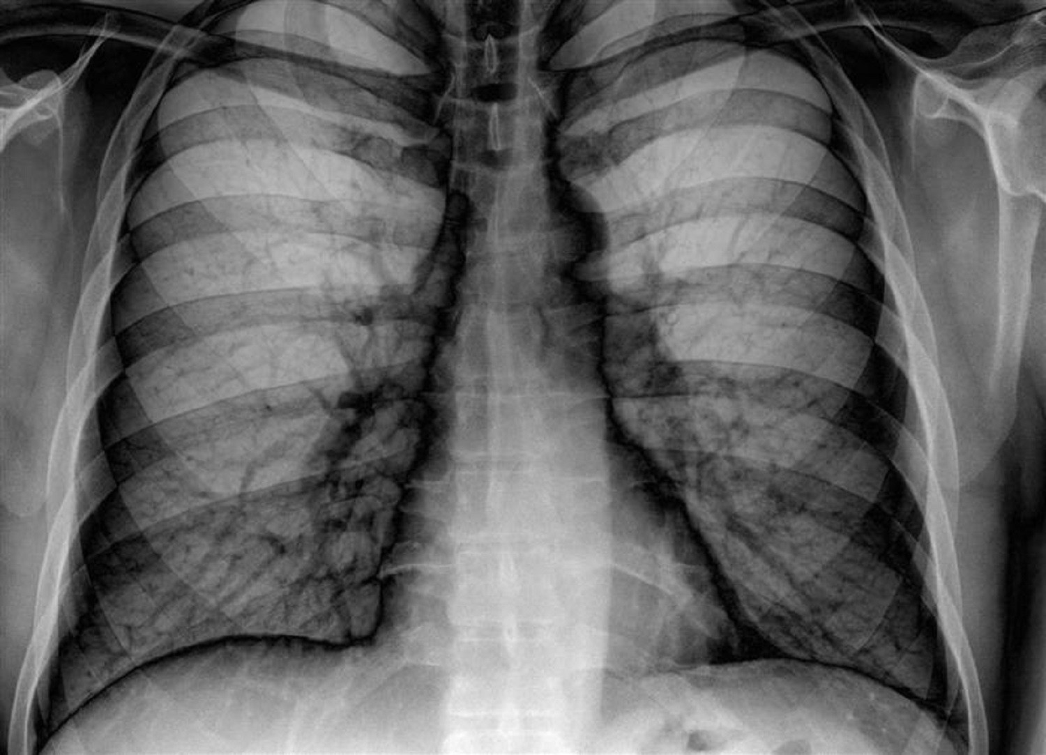 Σύστημα ερμηνεύει ακτινογραφίες πνευμόνων το ίδιο καλά με έμπειρους πνευμονολόγους