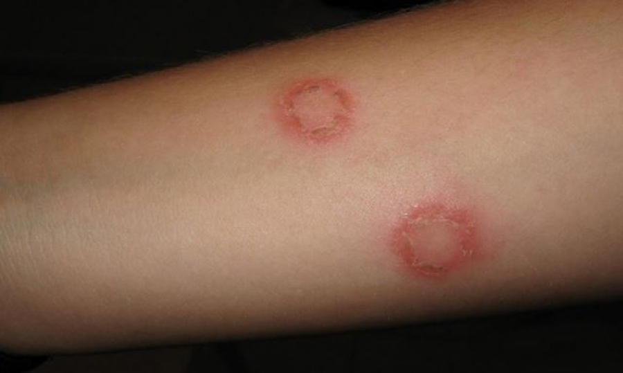 Tι πρέπει να γνωρίζετε για τις μυκητιάσεις στο δέρμα σας;