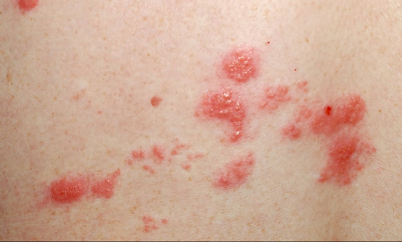 Έρπης ζωστήρας: Ποια τα συμπτώματα; – Πόσο εύκολα αντιμετωπίζεται;